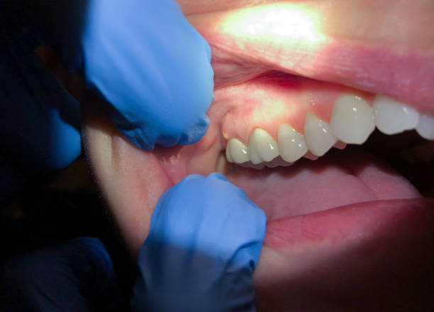 Best Emergency Dentist for Knocked-Out Tooth in Bonner West Riverside, MT